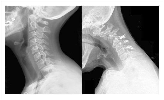 Alineamiento cervical