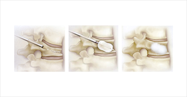 Cifoplastia