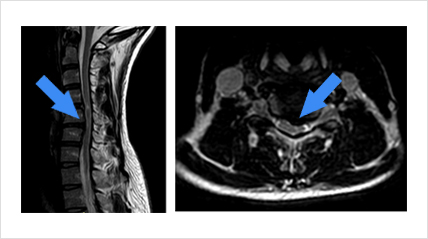 Hernia discal cervical