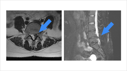 Hernia discal lumbar