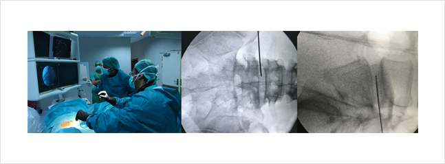 Nucleoplastia por radiofrecuencia