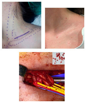 Síndrome desfiladero torácico costilla cervical