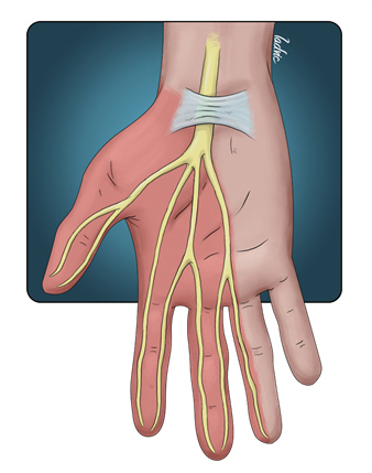 Túnel del carpo